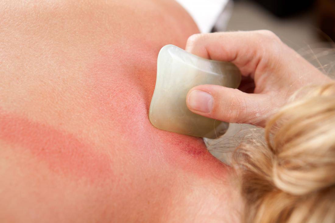 7. Gua Sha treatment